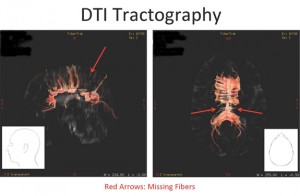 DTI Tractography